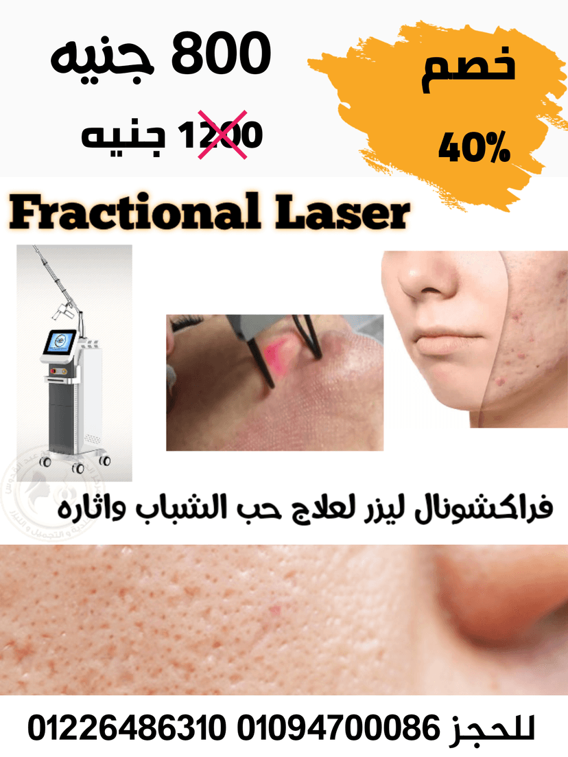 الفراكشنال ليزر (Fractional Laser) للبشره